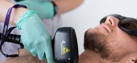 Epilare definitiva laser diode  barbati