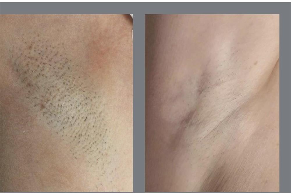 Epilare definitiva laser diode  barbati