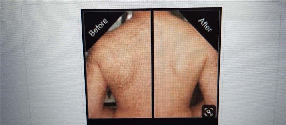 EPILAT, PENSAT, TUNS CORPORAL FEMEI SI BARBATI
