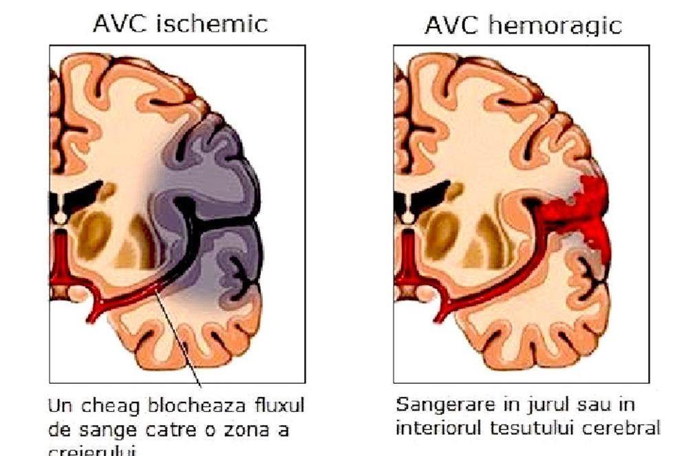 Recuperare Medicala Accident Vascular Cerebral