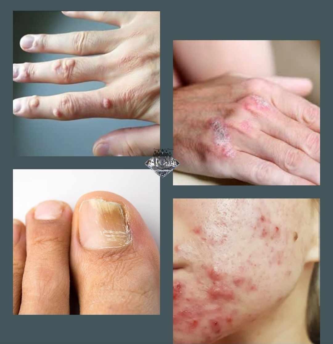 Stop micoza unghiilor